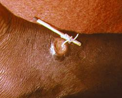 Foto: Guinea worm